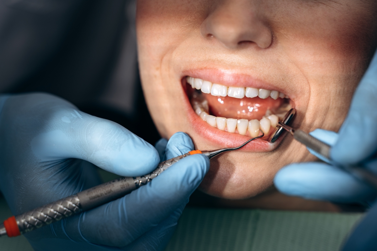 What Are All On   Dental Implants And How Do They Function?