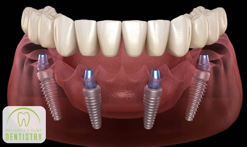 How Do I Know If I Am A Good Candidate For All On   Implant?