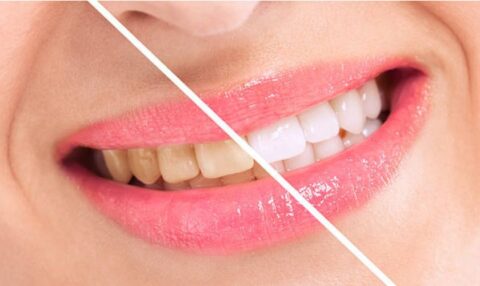 Best Professional Teeth Whiteners Laser Teeth Whitening vs. Bleaching