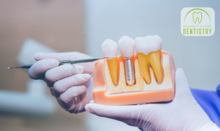 A Guide To Dental Implant Aftercare: What You Need To Know For Optimal Results