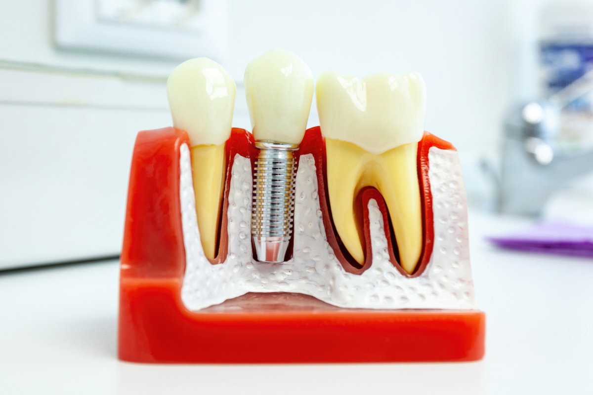 Everything You Should Know About Maintaining Healthy Dental Implants For A Lasting Smile