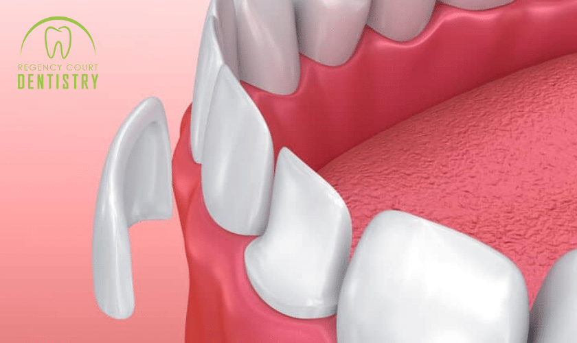 Essential Dental Veneer Aftercare Tips: Get A Dazzling Smile