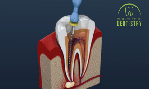 How To Deal With An Infected Root Canal