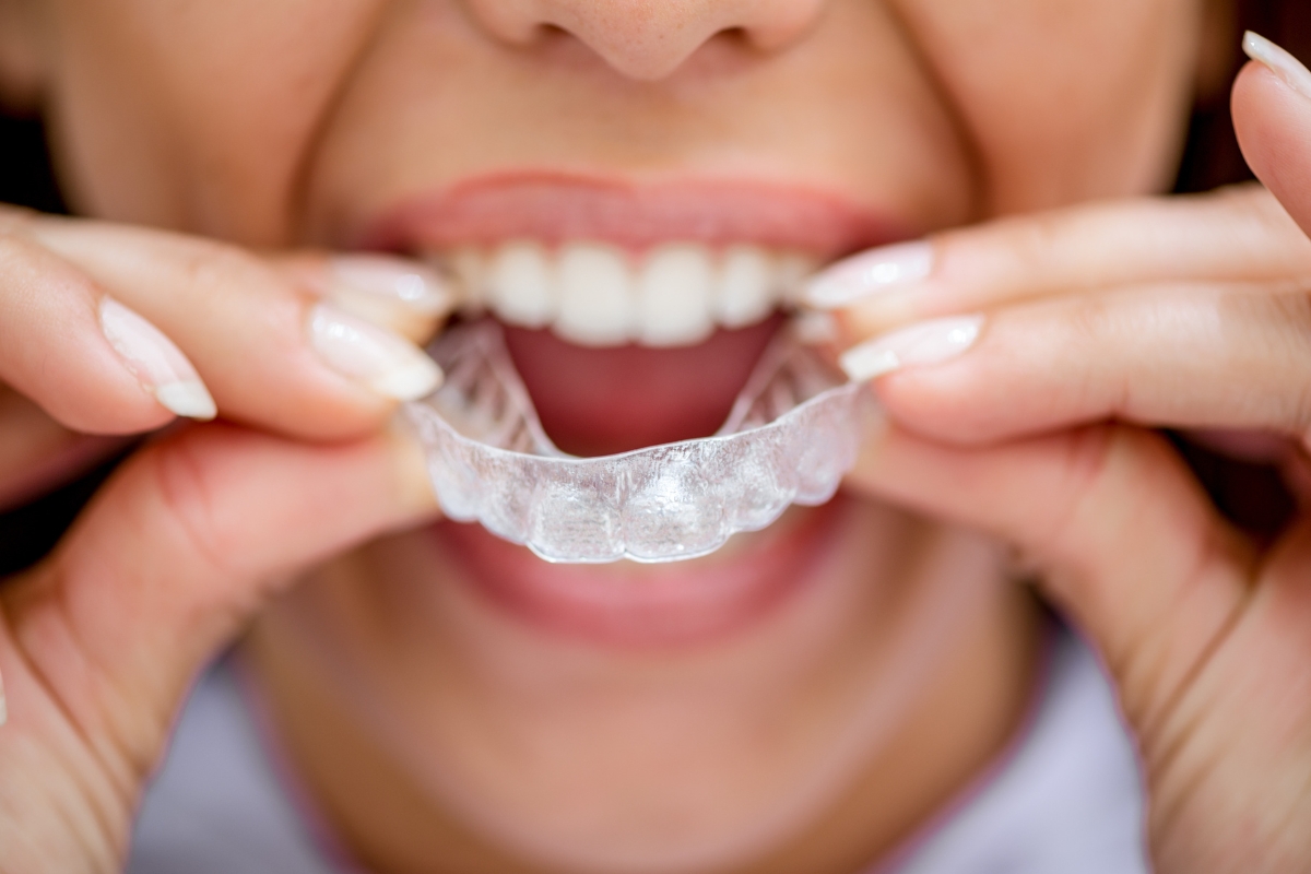 What To Do If Your Invisalign Clear Aligners Are Broken Or Missing