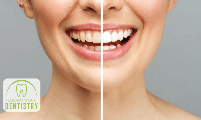 Is Professional Teeth Whitening Worth The Investment? Absolutely!
