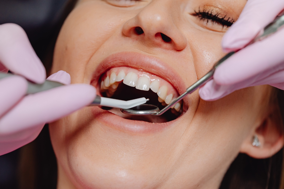 How Long Will A Root Canal Last?