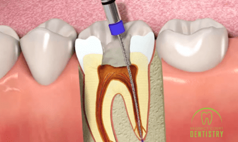The Importance Of Root Canal Treatment Aftercare