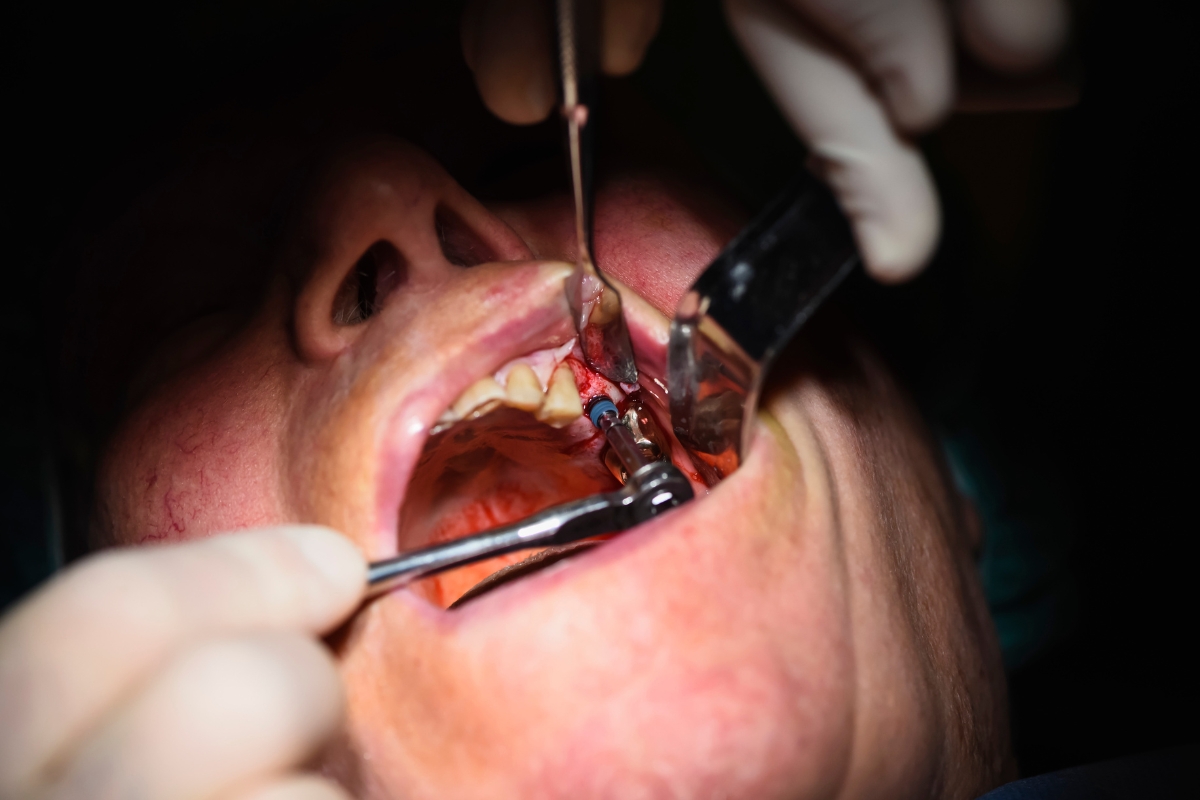 Recovery After Tooth Extraction: Expert Tips From A Boca Raton Dentist