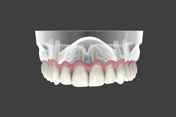 Are Implant Supported Dentures Permanent from Regency Court Dentistry in Boca Raton, FL