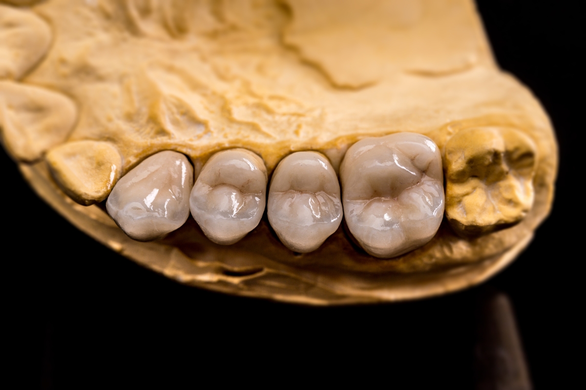 Dental Bridges Boca Del Mar: Restore Your Smile With Confidence