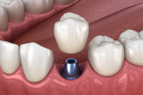 How A General Dentist Places A Dental Implant Crown
