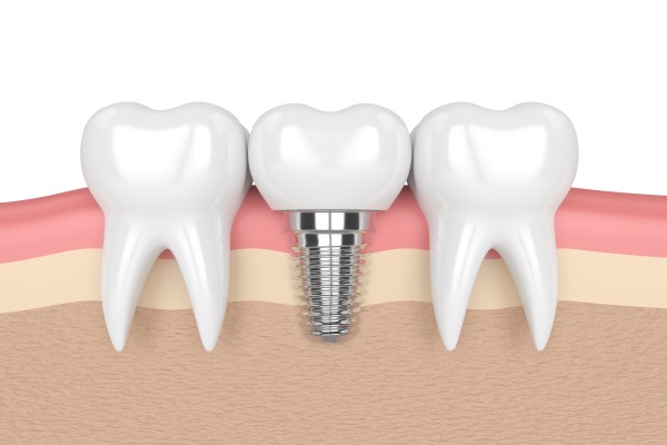 Timeline Of A Dental Implant Procedure