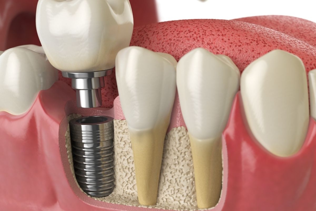 How Many Teeth Can A Single Dental Implant Support?