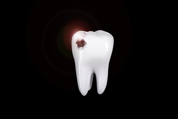 Save Teeth With A Cavity Treatment