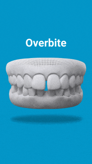 Overbite