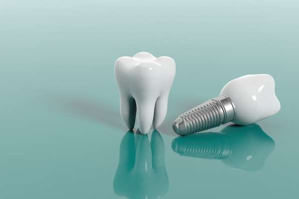 Multiple Teeth Replacement Options: One Implant for Two Teeth from Regency Court Dentistry in Boca Raton, FL