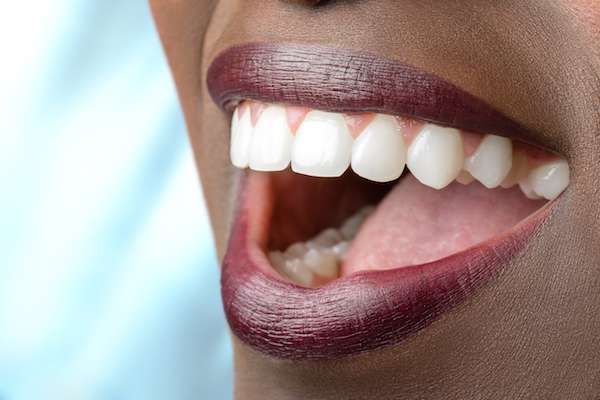 Routine Dental Care: What Are Tooth Colored Fillings from Regency Court Dentistry in Boca Raton, FL